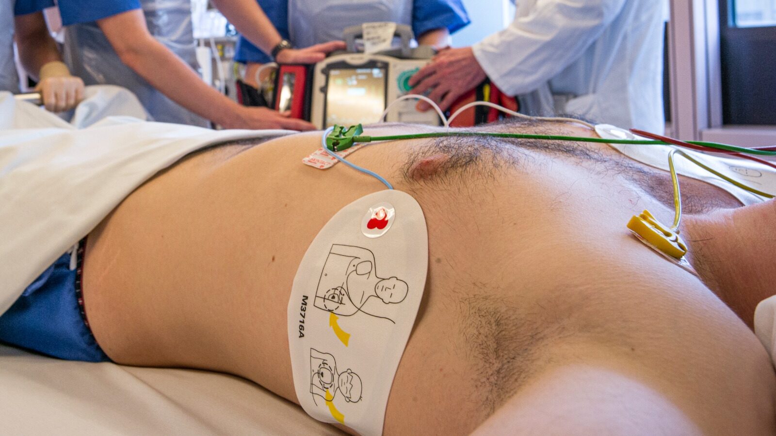 Potilas, jolle kiinnitetty defibrillointi-elektrodit.