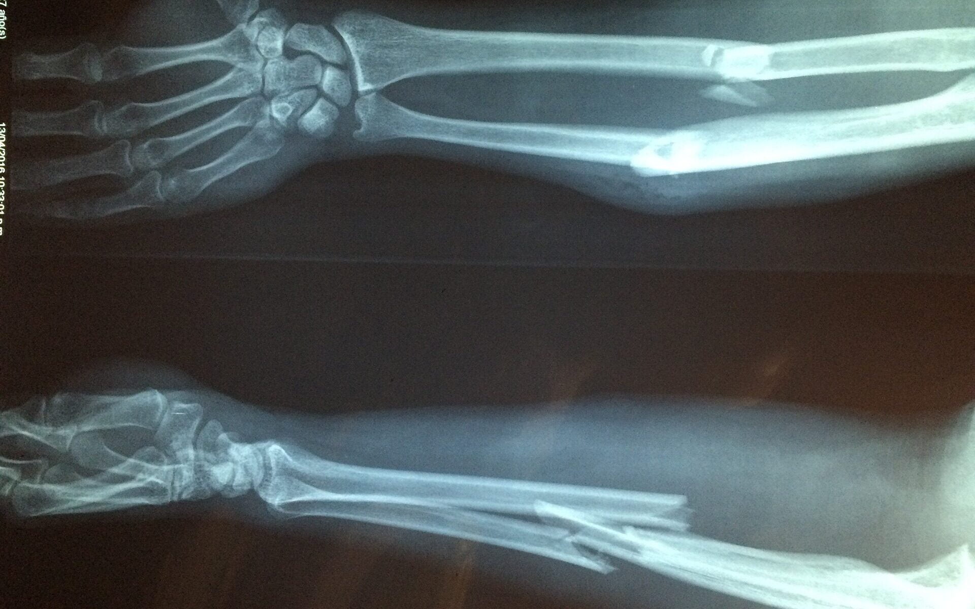 Röntgen kuva murtuneesta kädestä.